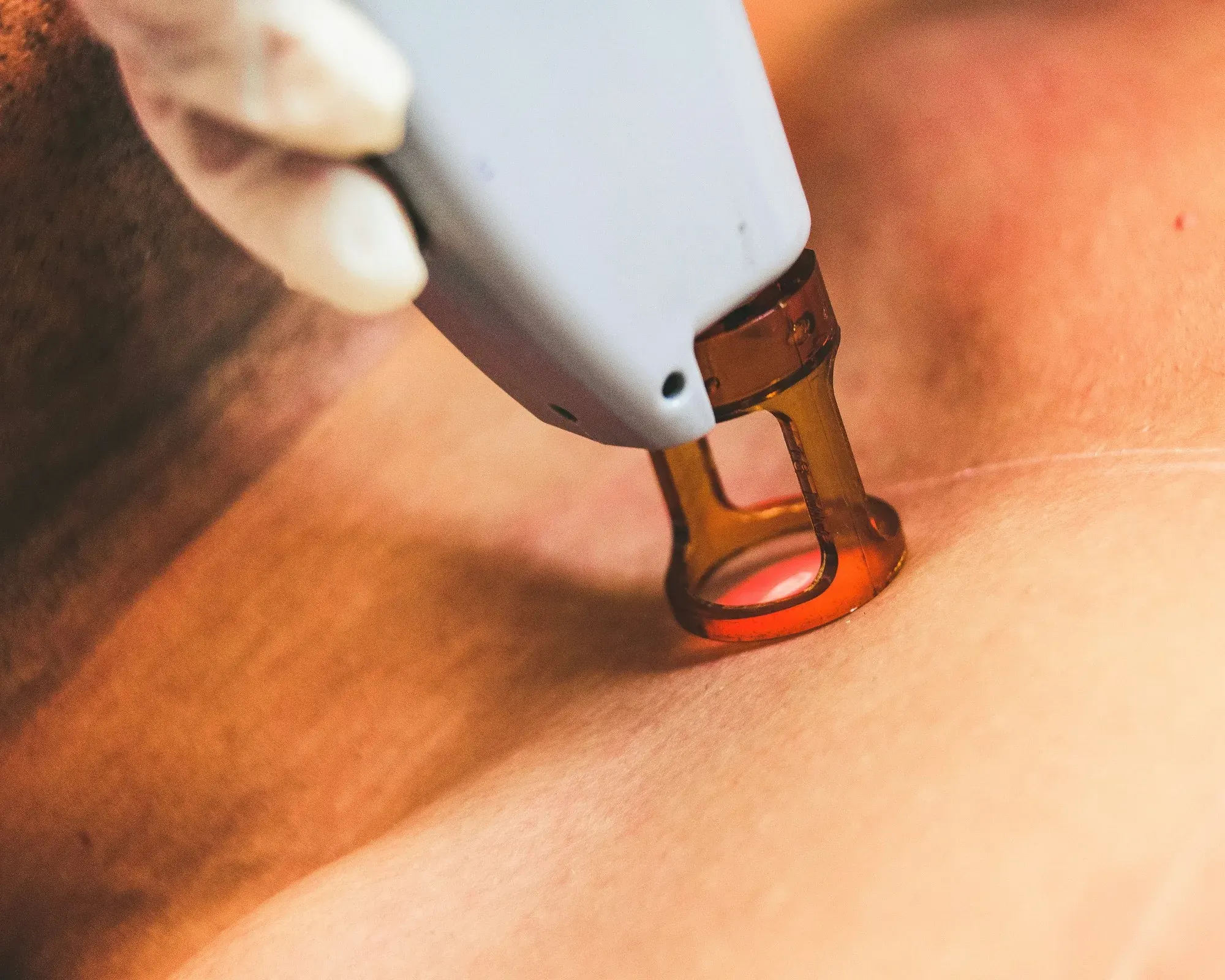 Epilazione laser donna a Milano